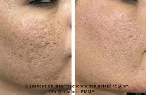 reduction des cicatrices d'acne par laser avant-apres