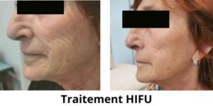 Traitement HIFU