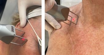 CoolPeel sur visage et décolleté