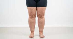 Lipœdème : affiner le diagnostic différentiel en médecine esthétique lipoedeme des jambes