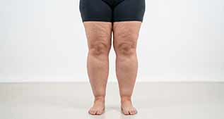 lipoedeme des jambes